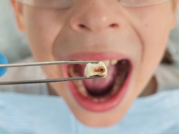 Best Knocked-Out Tooth (Avulsed Tooth) Treatment in Lake Stickney, WA